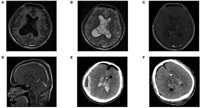 Clinical Outcome After Microsurgical Resection of Central Neurocytoma: A Single-Centre Analysis of 15 Years